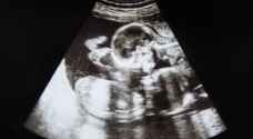 Video: Twin sisters filmed 'fighting' inside mother's womb
