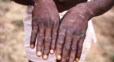 Here are the symptoms of monkeypox
