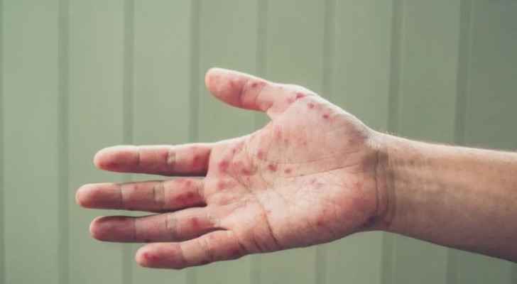 WHO classifies monkeypox as high risk in Europe